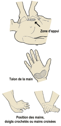 La compression thoracique